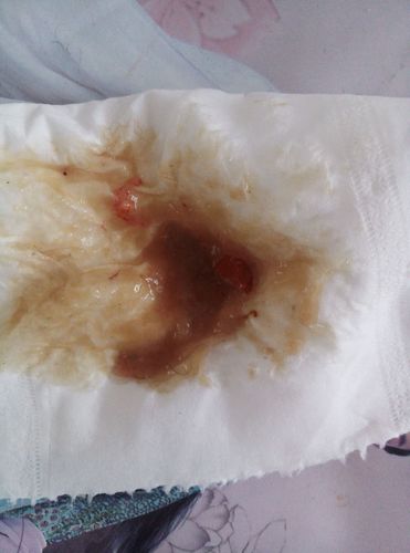 新澳门开奖记录新纪录和女童呕吐活虫一个月与孩子吐出来有活虫子